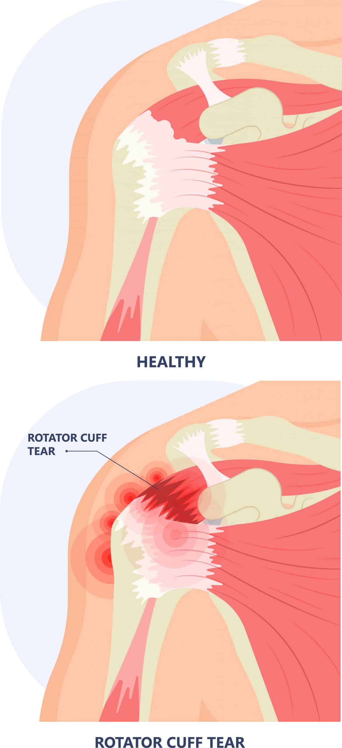 rotator cuff ruptuur - Fysiotherapie de Jong