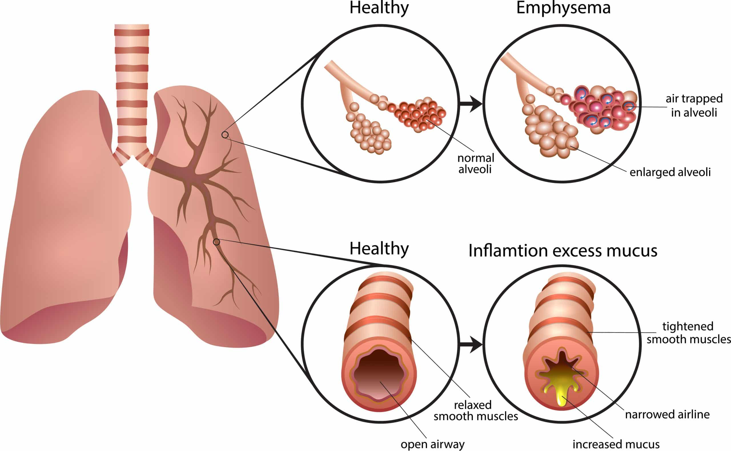 COPD - Fysiotherapie de Jong