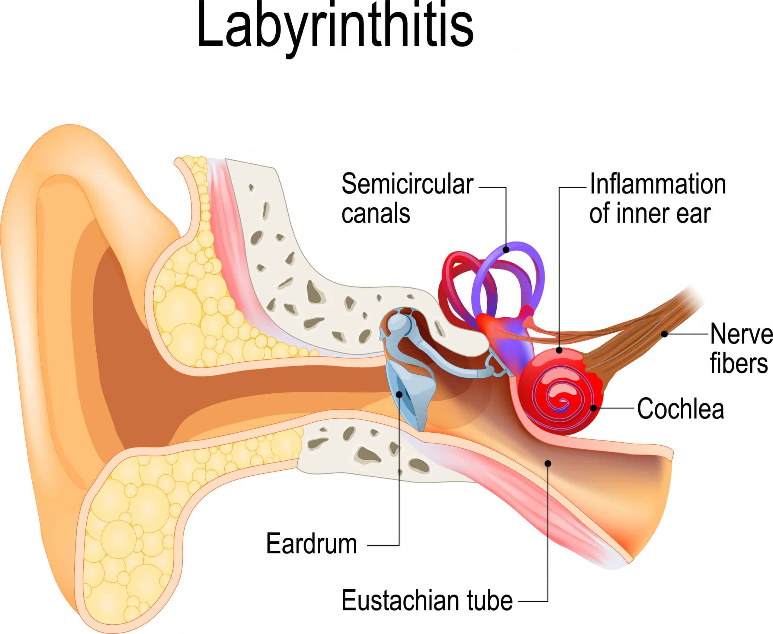 labyrinthitis - Fysiotherapie de Jong